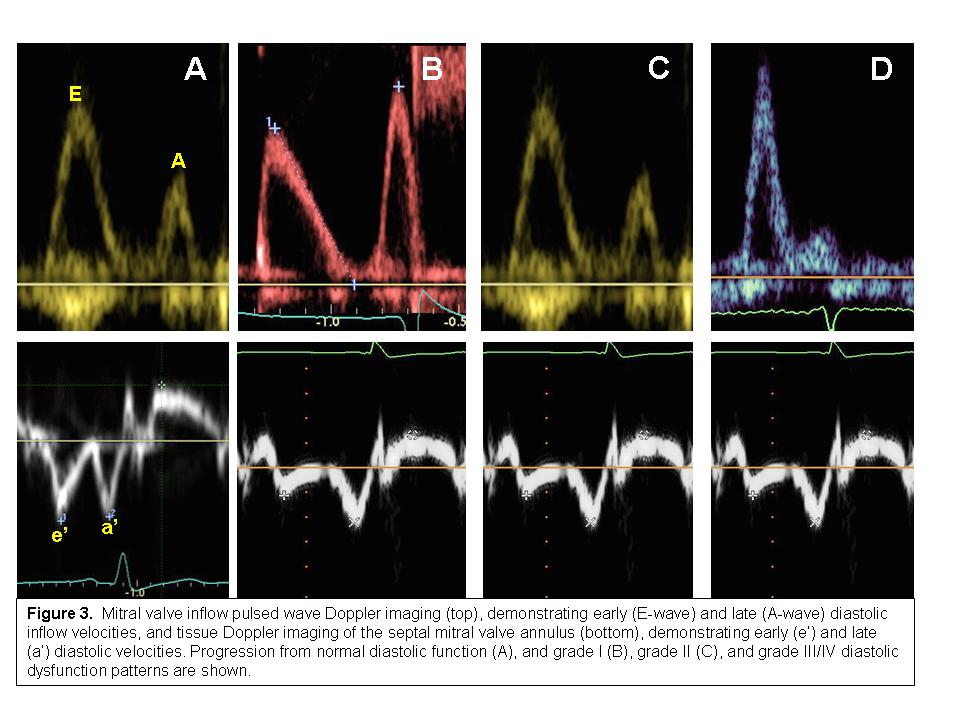 Grade 2 Diastolic Dysfunction