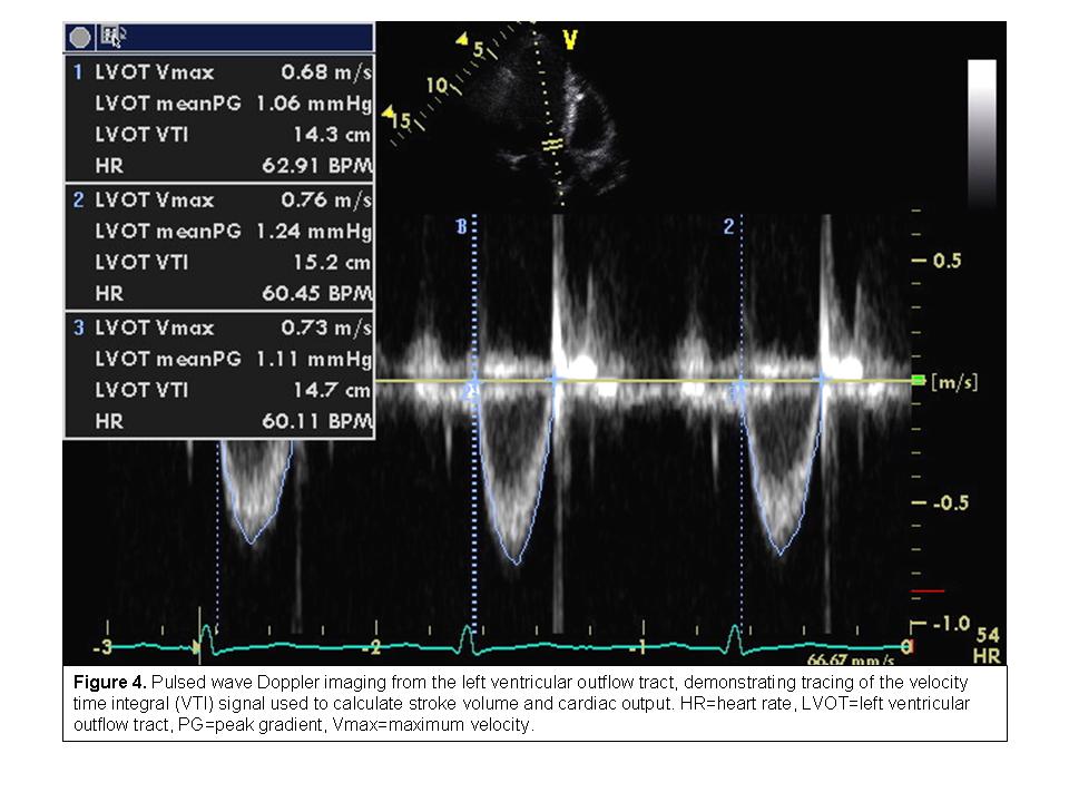 Use of the Echocardiogram to Define the Presence, Extent 